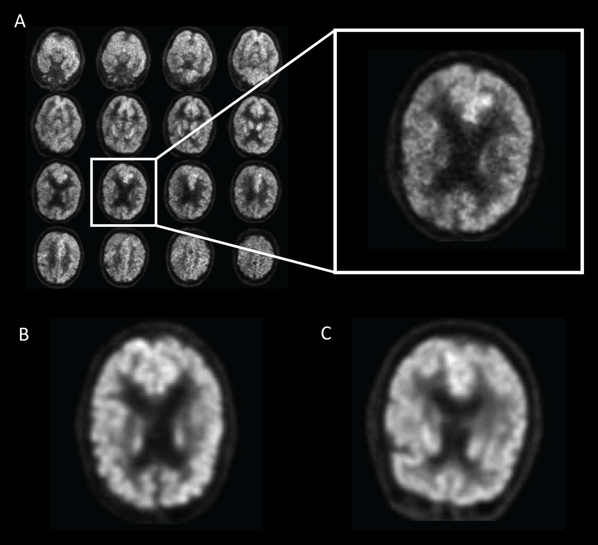 AI ตรวจเจอสัญญาก่อโรคอัลไซเมอร์ก่อนหมอนานถึง 6 เดือน 2 AI and Alzheimer 1